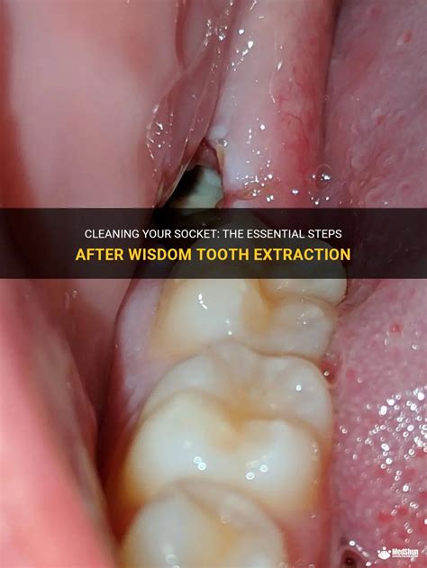 can i shower after wisdom teeth removal|Can You Actually Shower After a Wisdom Teeth。